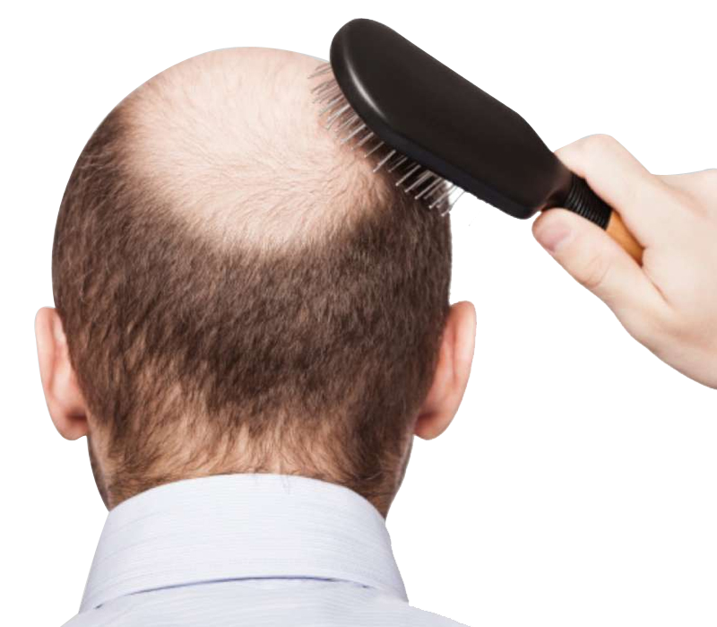 Which hair loss treatment is best for you  HealthShots